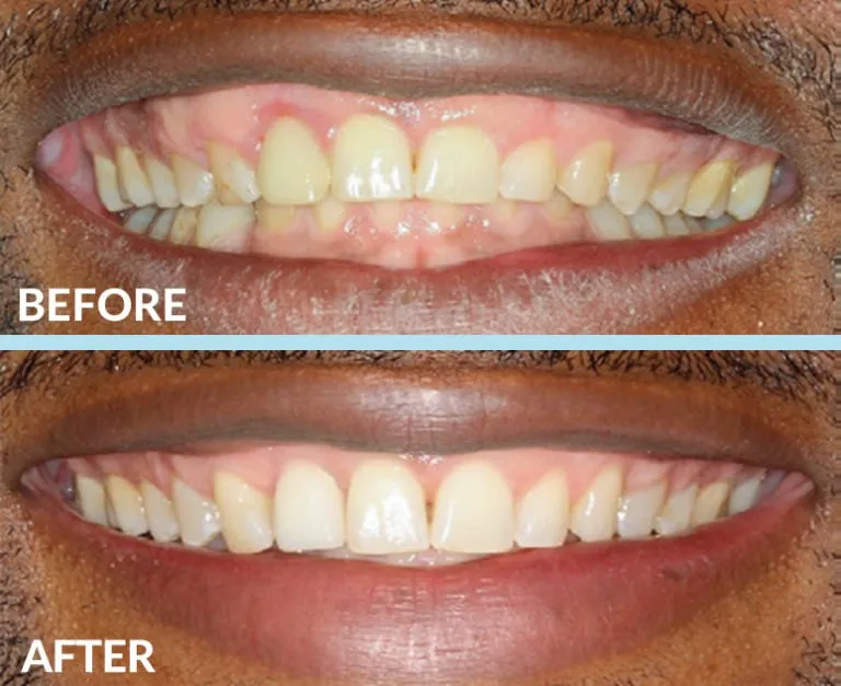 Before and after gummy smile correction showing reduced gum display and improved smile aesthetics