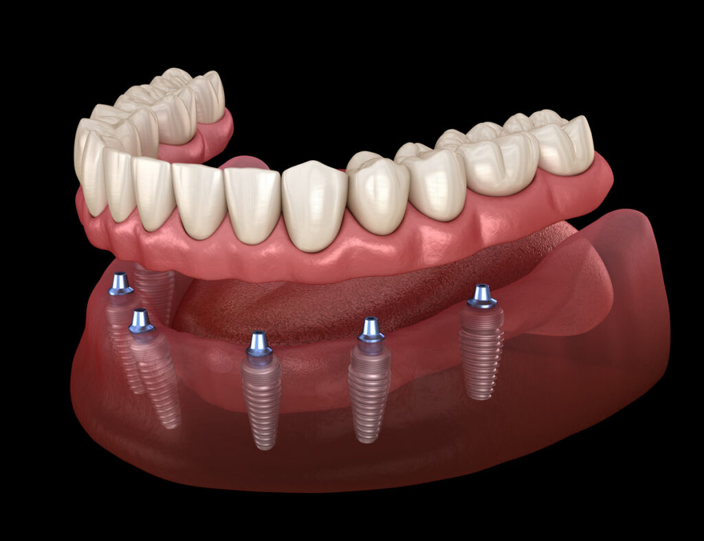 Mandibular prosthesis All on 6 system supported by implants. Medically accurate 3D illustration of human teeth and dentures concept