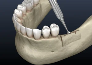 Cleavage of the alveolar ridge, augmentation
