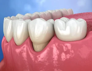 Close-up 3D render of healthy teeth and gums, showing slight gum recession