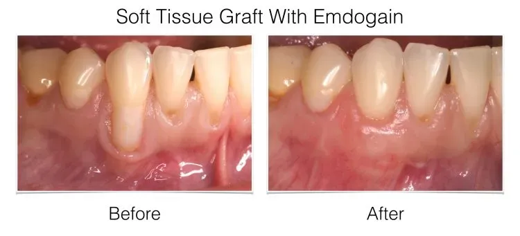 img3 - Periodontist Philadelphia | Laudenbach Periodontics & Dental Implants