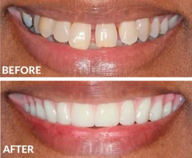 Dental case before-and-after showing damaged teeth restored to bright, uniform white smile