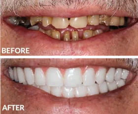 Dental restoration before-and-after with severely decayed teeth transformed to bright white smile
