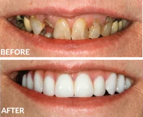 Dental case before-and-after showing damaged teeth restored to white, even smile