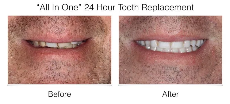 Dental Implants – “All In One” 24 Hour Tooth Replacement before and after