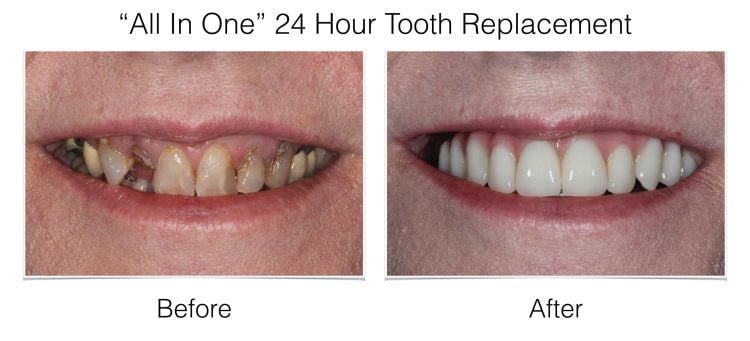 Dental Implants – “All In One” 24 Hour Tooth Replacement before and after