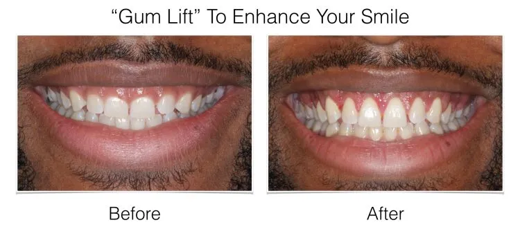 Cosmetic Periodontal Surgery before and after