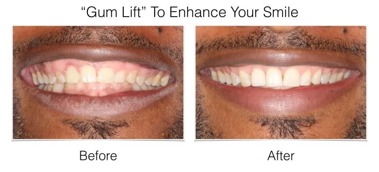 Smile Gallery before and after
