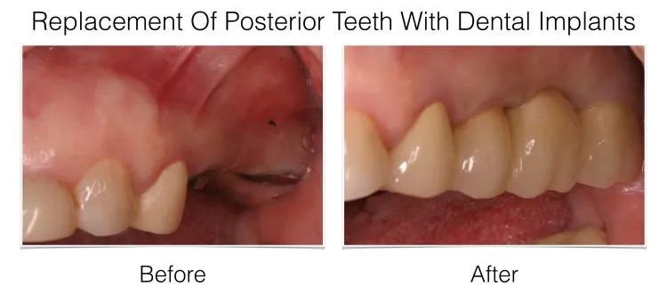 Dental Implants – Posterior Teeth before and after
