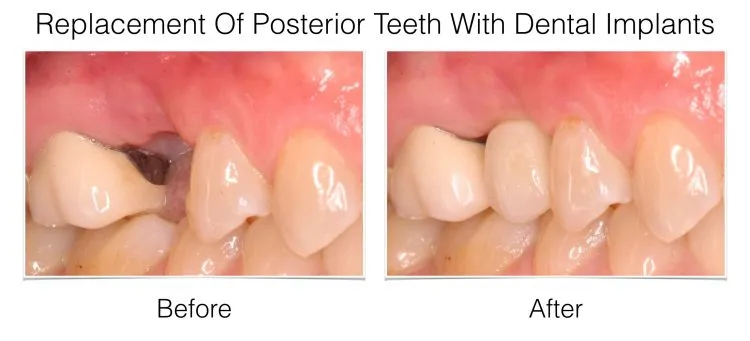Dental Implants – Posterior Teeth before and after