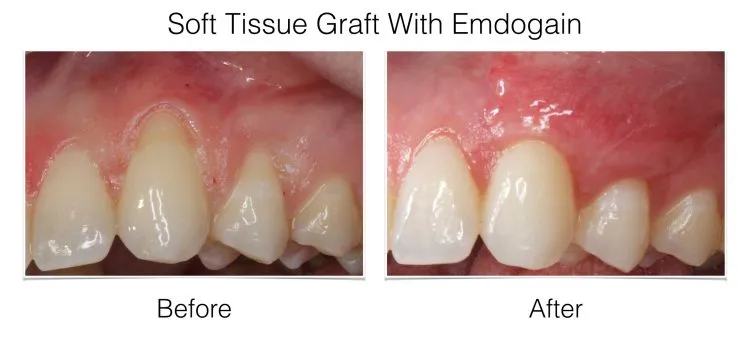 Soft Tissue Grafting before and after