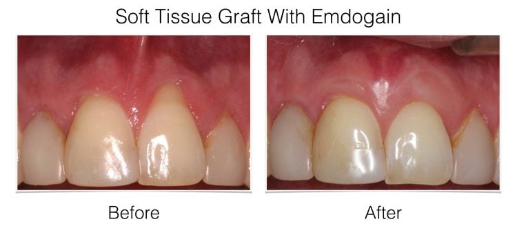 Soft Tissue Grafting before and after