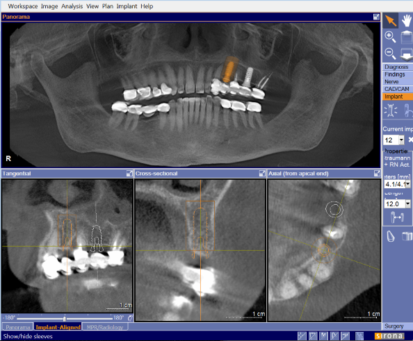 Evaluation of Dental Implants